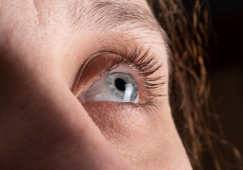 Eye of a woman with keratoconus thinning of the cornea
